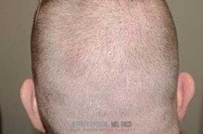 Before & After Hair Transplants For Men Case 68 View 3 View in Miami, FL