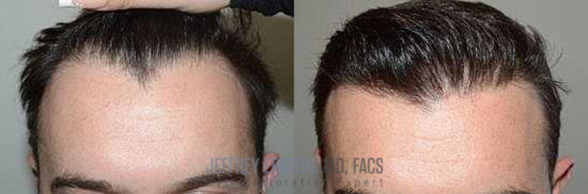 Before & After Hair Transplants For Men Case 7 View 1 View in Miami, FL