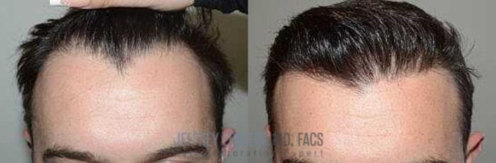 Before & After Hair Transplants For Men Case 7 View 1 View in Miami, FL