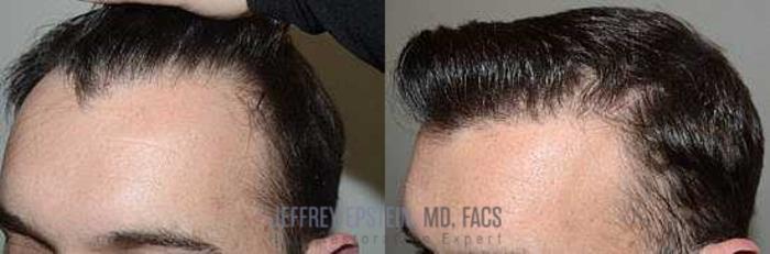 Before & After Hair Transplants For Men Case 7 View 2 View in Miami, FL