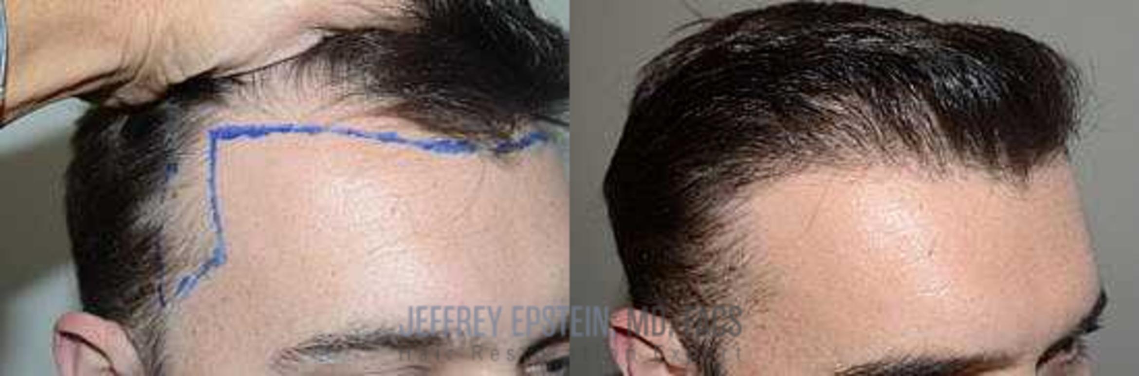 Before & After Hair Transplants For Men Case 7 View 3 View in Miami, FL