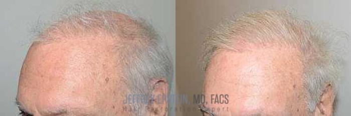 Before & After Hair Transplants For Men Case 71 View 1 View in Miami, FL