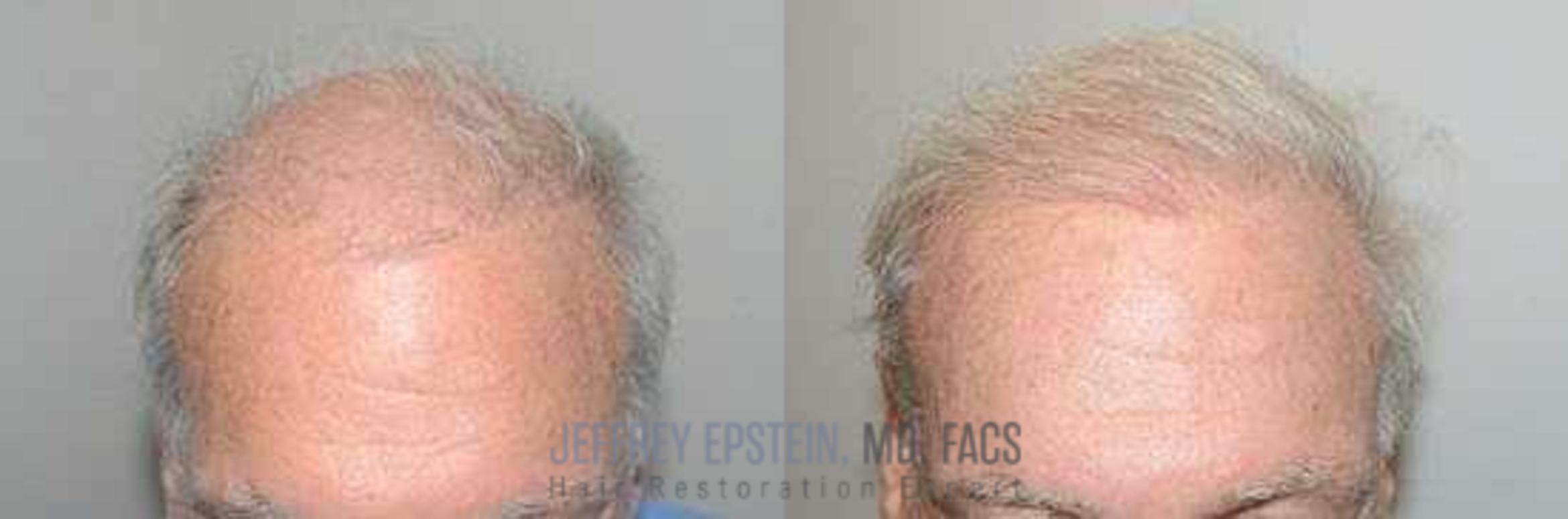 Before & After Hair Transplants For Men Case 71 View 2 View in Miami, FL