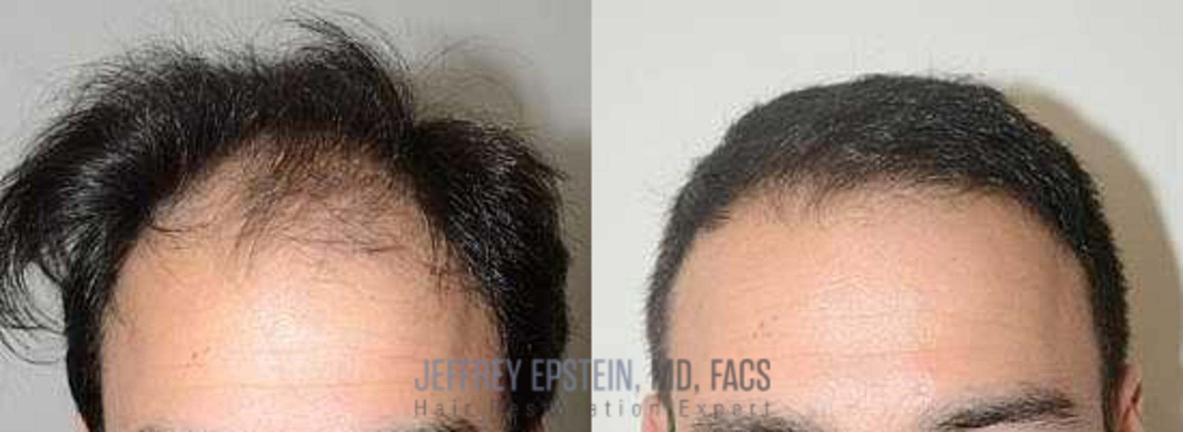 Before & After Hair Transplants For Men Case 73 View 1 View in Miami, FL