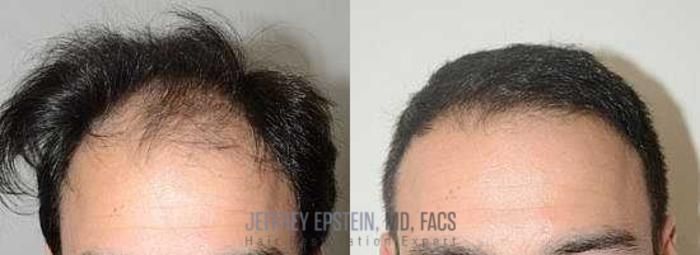 Before & After Hair Transplants For Men Case 73 View 1 View in Miami, FL