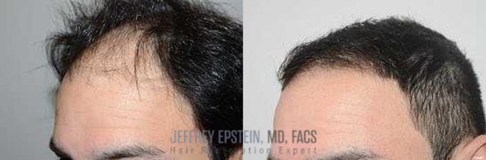 Before & After Hair Transplants For Men Case 73 View 2 View in Miami, FL