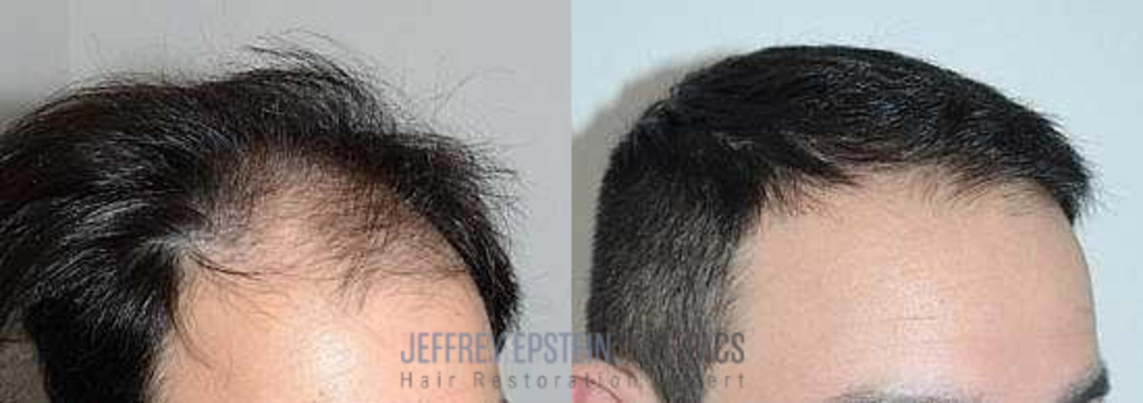 Before & After Hair Transplants For Men Case 73 View 3 View in Miami, FL
