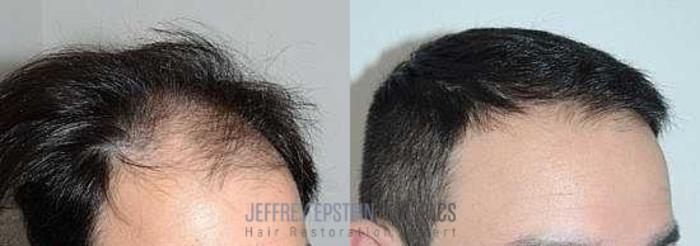 Before & After Hair Transplants For Men Case 73 View 3 View in Miami, FL