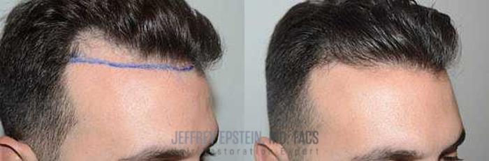 Before & After Hair Transplants For Men Case 75 View 1 View in Miami, FL