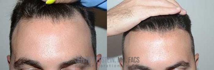 Before & After Hair Transplants For Men Case 75 View 2 View in Miami, FL