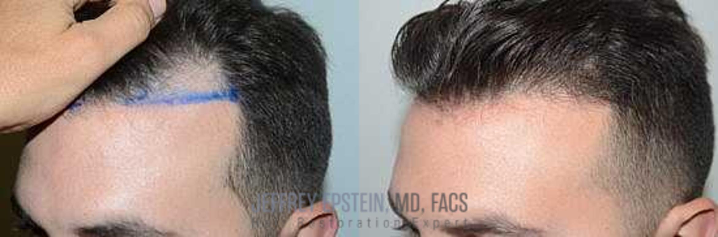 Before & After Hair Transplants For Men Case 75 View 3 View in Miami, FL
