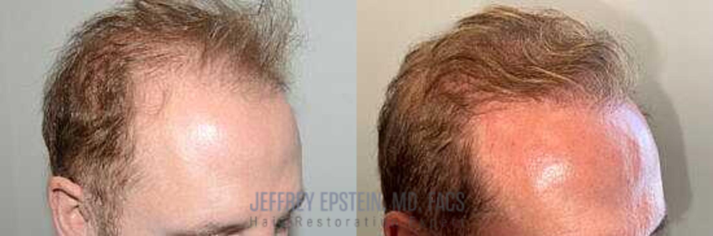 Before & After Hair Transplants For Men Case 76 View 1 View in Miami, FL