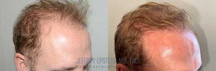 Before & After Body Hair Transplant (BHT) Case 76 View 1 View in Miami, FL