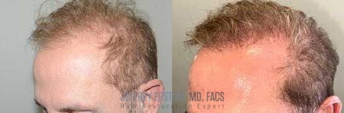 Before & After Hair Transplants For Men Case 76 View 2 View in Miami, FL