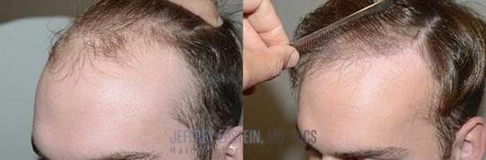 Before & After Hair Transplants For Men Case 77 View 1 View in Miami, FL