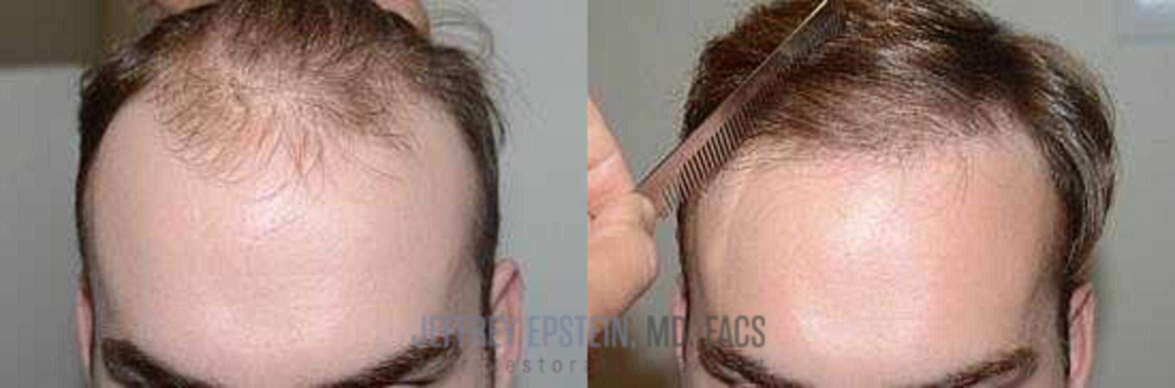 Before & After Hair Transplants For Men Case 77 View 2 View in Miami, FL