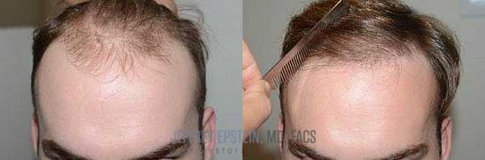 Before & After Hair Transplants For Men Case 77 View 2 View in Miami, FL