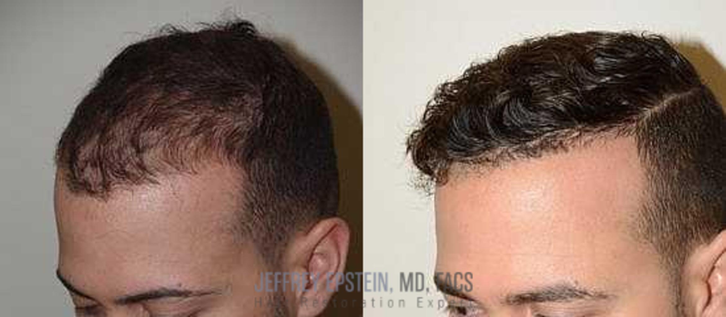 Before & After Hair Transplants For Men Case 78 View 1 View in Miami, FL
