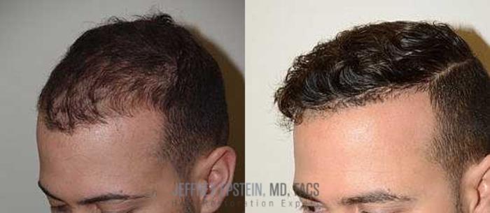 Before & After Hair Transplants For Men Case 78 View 1 View in Miami, FL