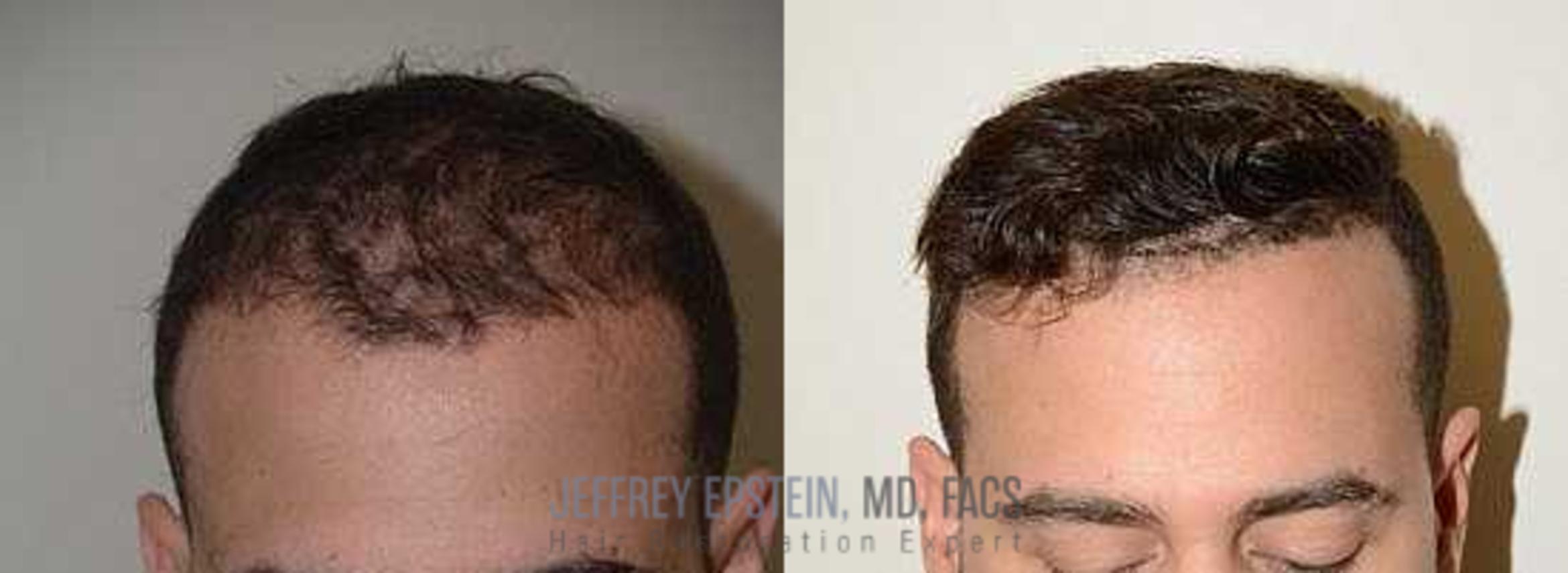 Before & After Hair Transplants For Men Case 78 View 2 View in Miami, FL