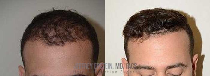 Before & After Hair Transplants For Men Case 78 View 2 View in Miami, FL