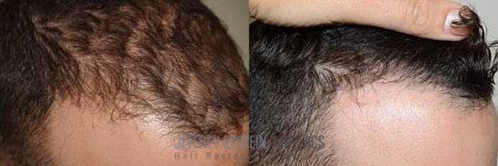 Before & After Hair Transplants For Men Case 78 View 3 View in Miami, FL