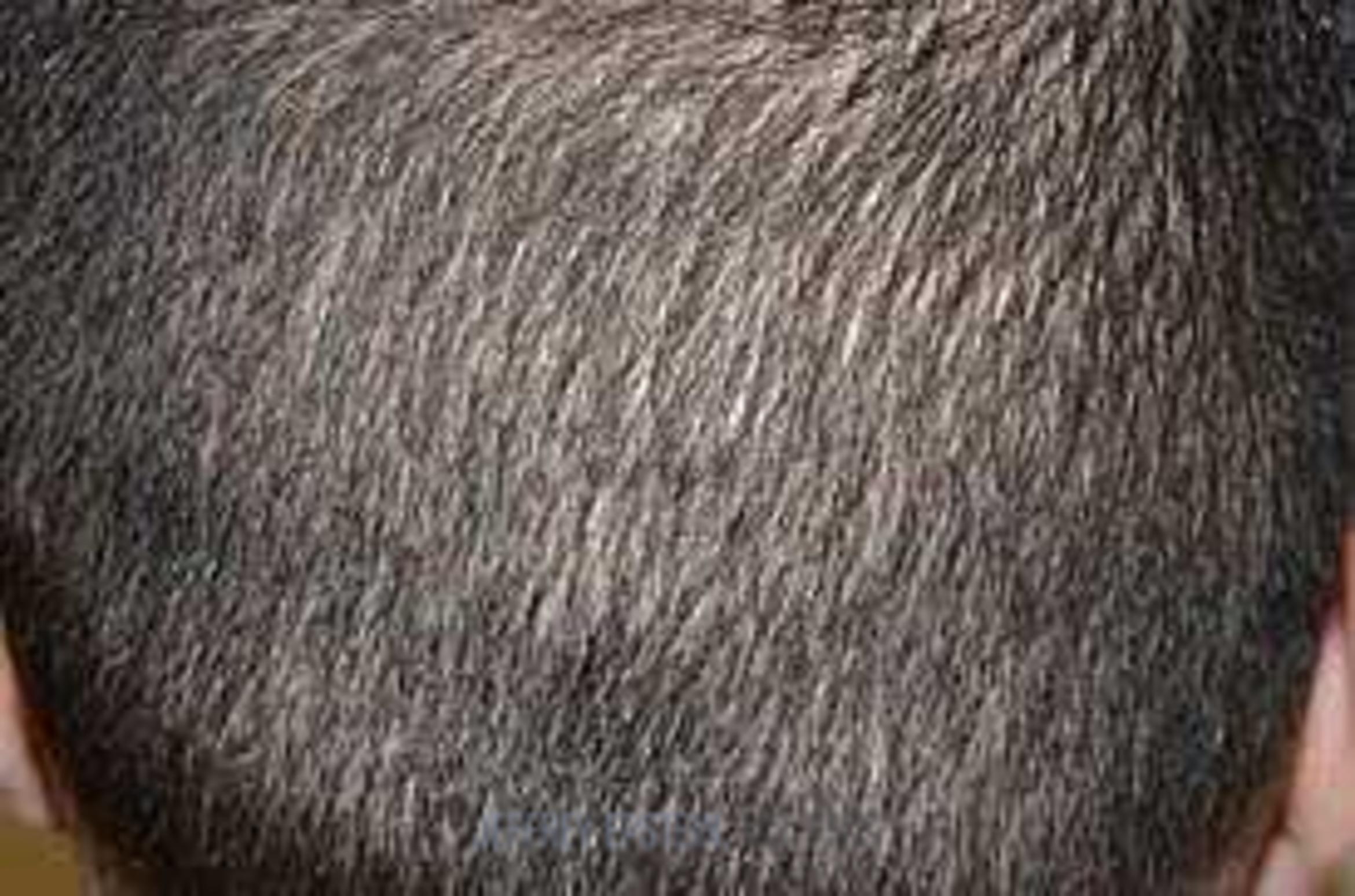 Before & After Hair Transplants For Men Case 78 View 4 View in Miami, FL