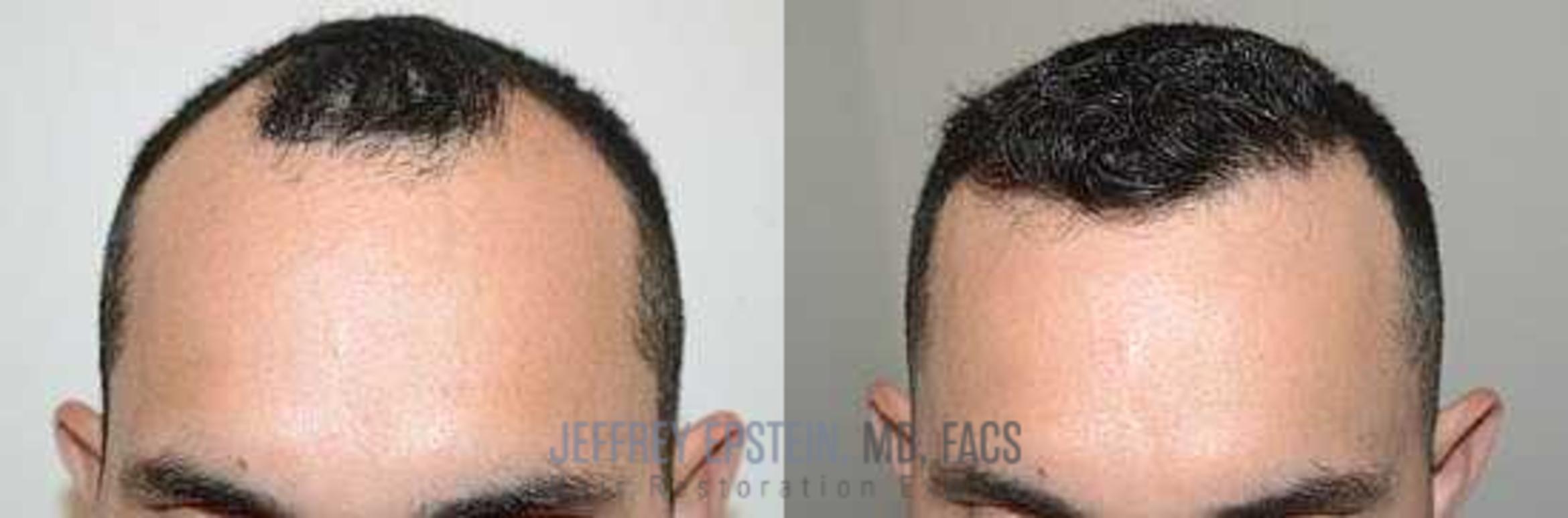 Before & After Hair Transplants For Men Case 80 View 1 View in Miami, FL