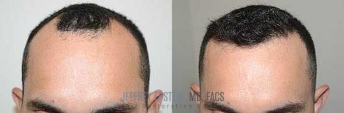 Before & After Hair Transplants For Men Case 80 View 1 View in Miami, FL