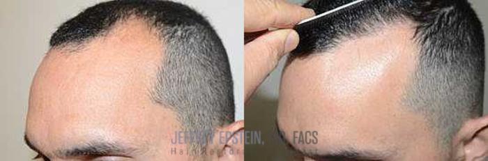Before & After Hair Transplants For Men Case 80 View 2 View in Miami, FL