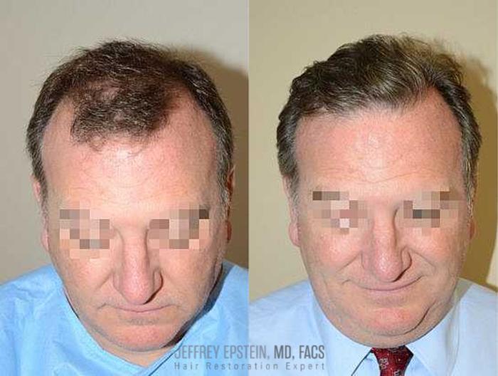 Before & After Hair Transplants For Men Case 82 View 1 View in Miami, FL
