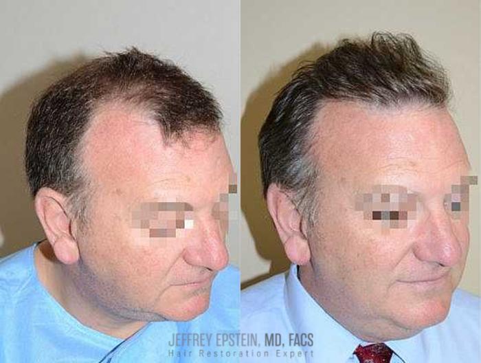 Before & After Hair Transplants For Men Case 82 View 2 View in Miami, FL