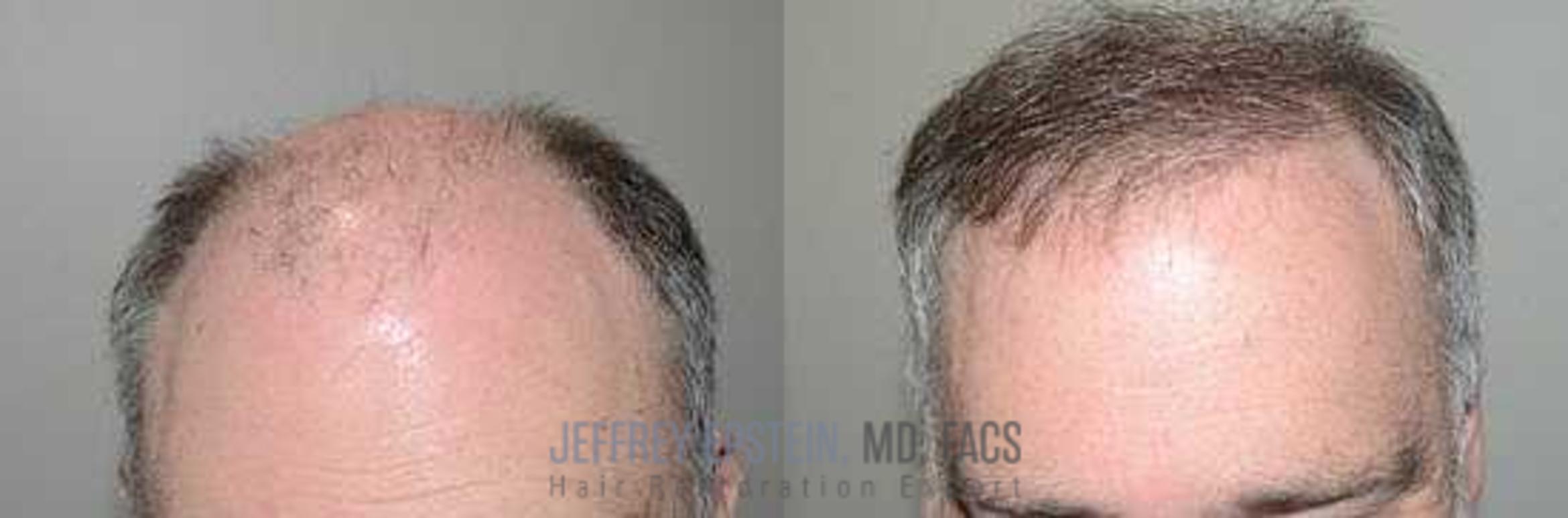 Before & After Hair Transplants For Men Case 83 View 1 View in Miami, FL