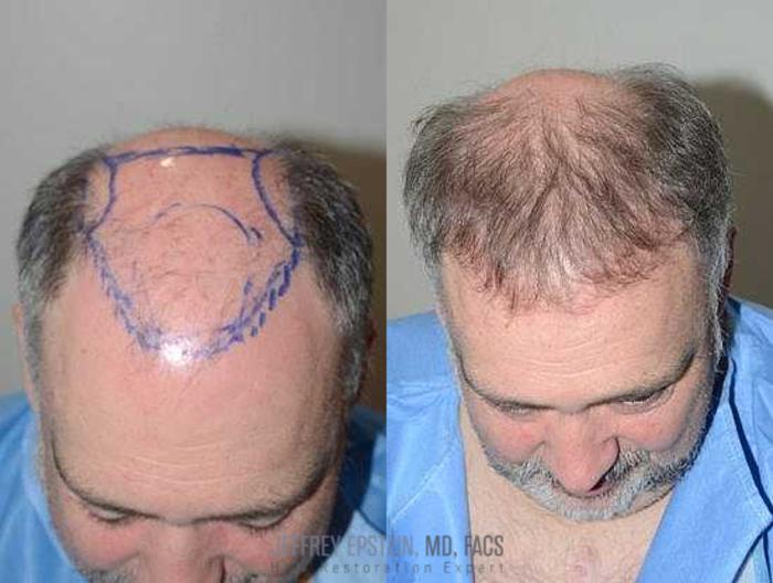Before & After Hair Transplants For Men Case 83 View 2 View in Miami, FL