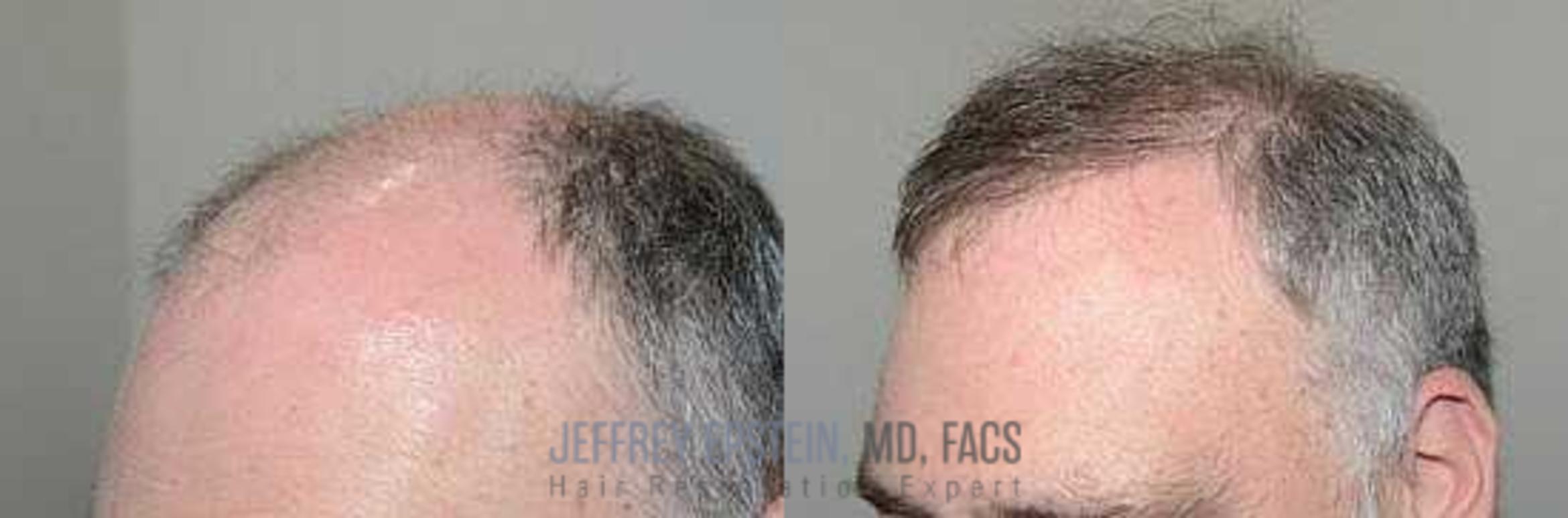 Before & After Hair Transplants For Men Case 83 View 3 View in Miami, FL