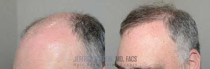 Before & After Hair Transplants For Men Case 83 View 3 View in Miami, FL