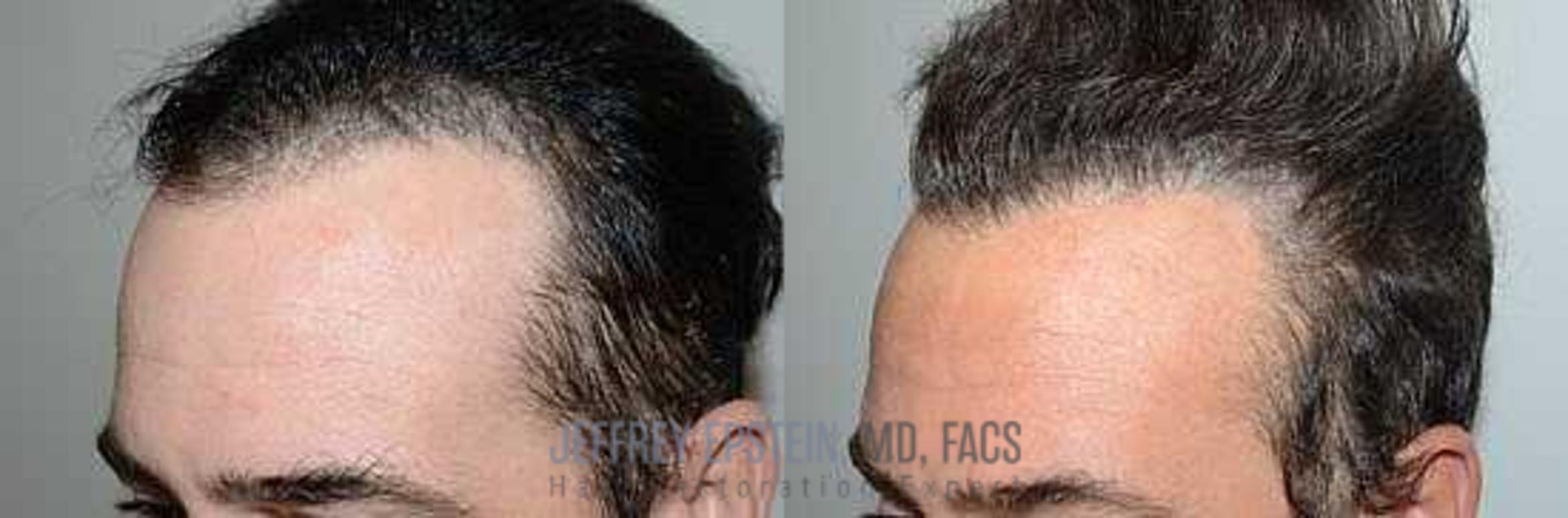 Before & After Hair Transplants For Men Case 84 View 1 View in Miami, FL
