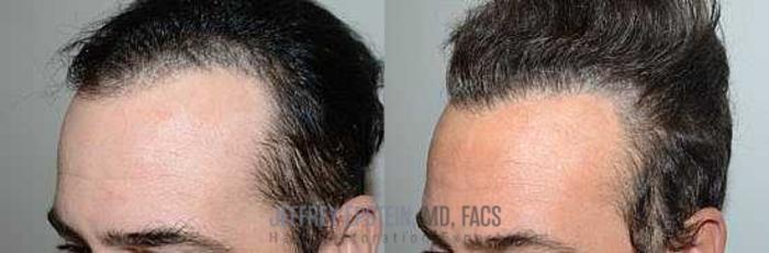 Before & After Hair Transplants For Men Case 84 View 1 View in Miami, FL