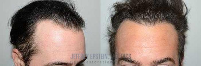 Before & After Hair Transplants For Men Case 84 View 2 View in Miami, FL