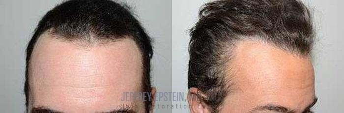 Before & After Hair Transplants For Men Case 84 View 3 View in Miami, FL