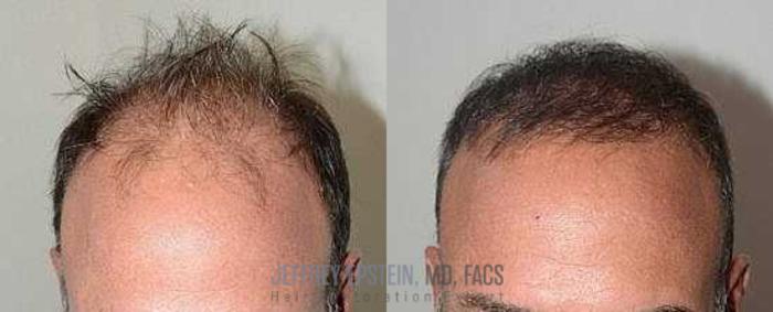Before & After Hair Transplants For Men Case 85 View 1 View in Miami, FL
