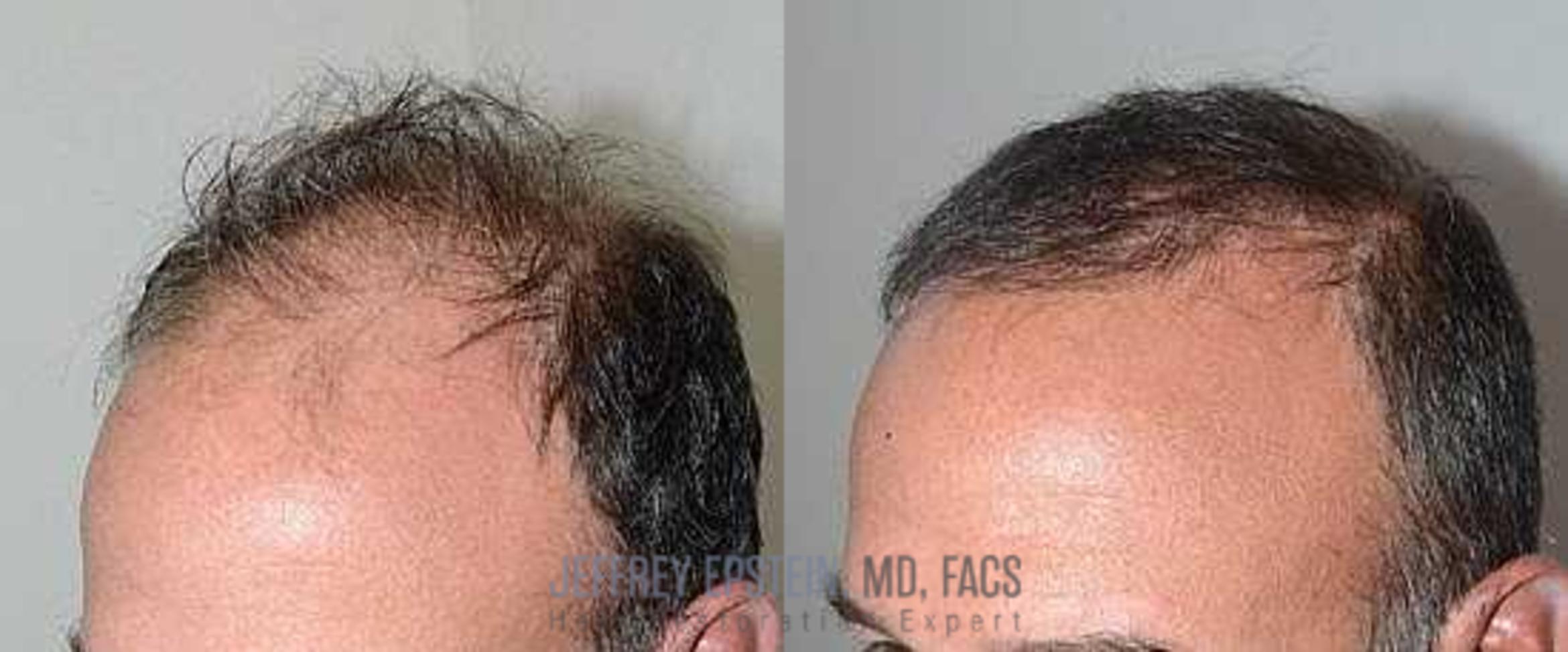 Before & After Hair Transplants For Men Case 85 View 2 View in Miami, FL