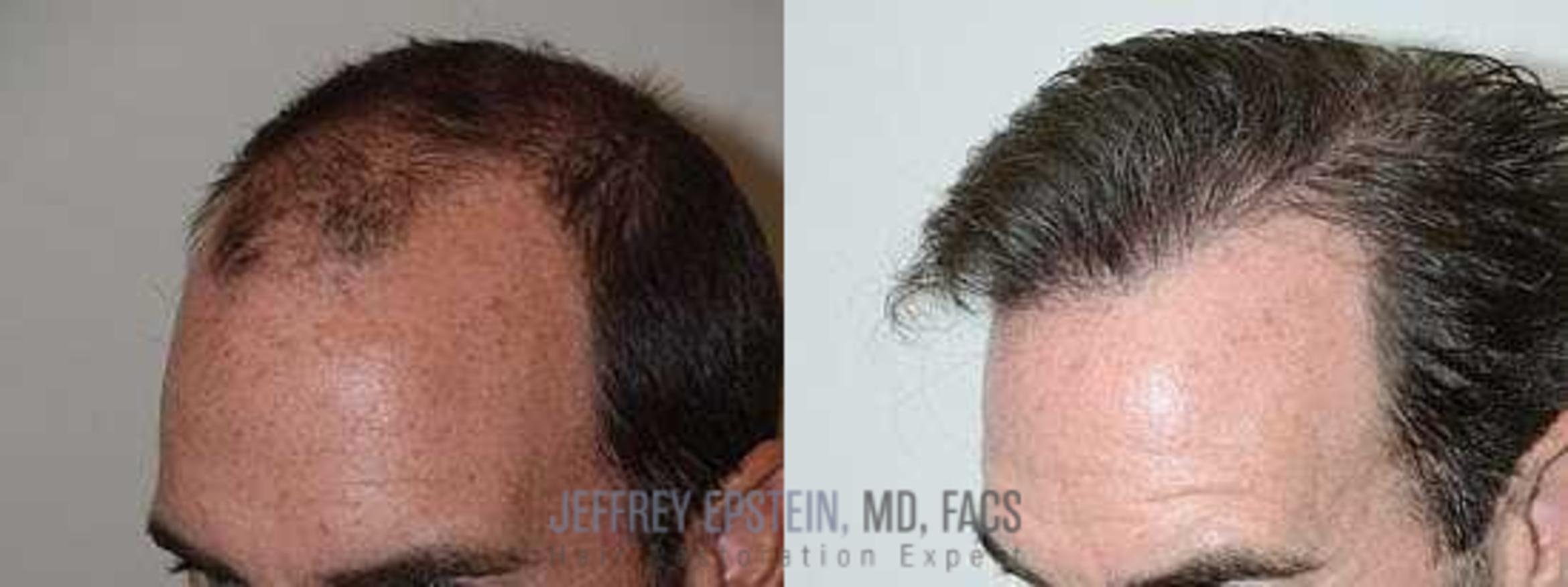 Before & After Hair Transplants For Men Case 86 View 1 View in Miami, FL