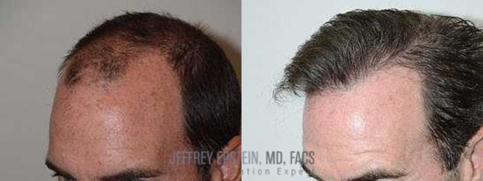 Before & After Hair Transplants For Men Case 86 View 1 View in Miami, FL