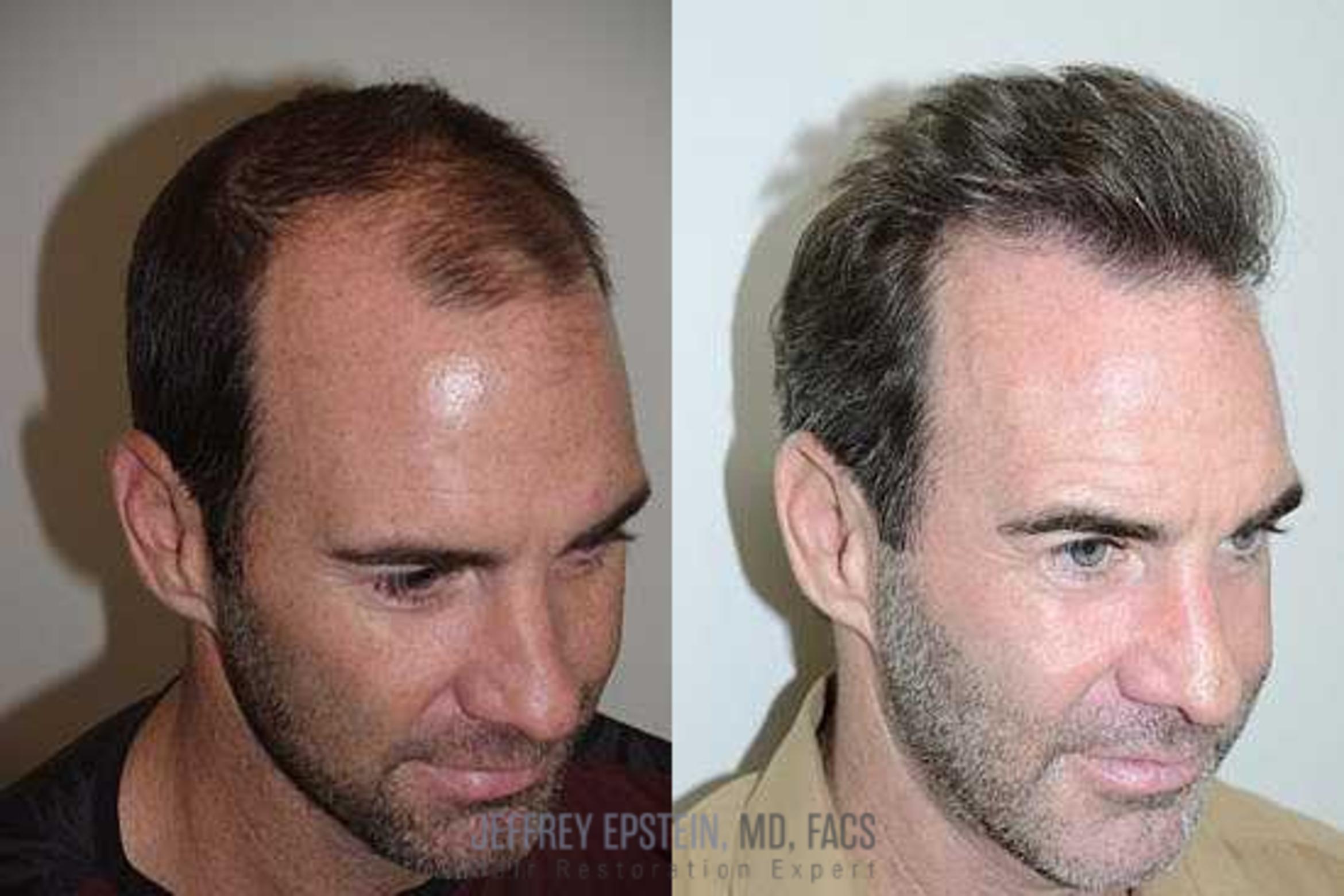 Before & After Hair Transplants For Men Case 86 View 2 View in Miami, FL
