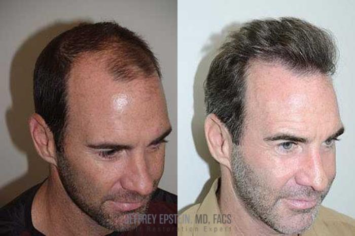 Before & After Hair Transplants For Men Case 86 View 2 View in Miami, FL
