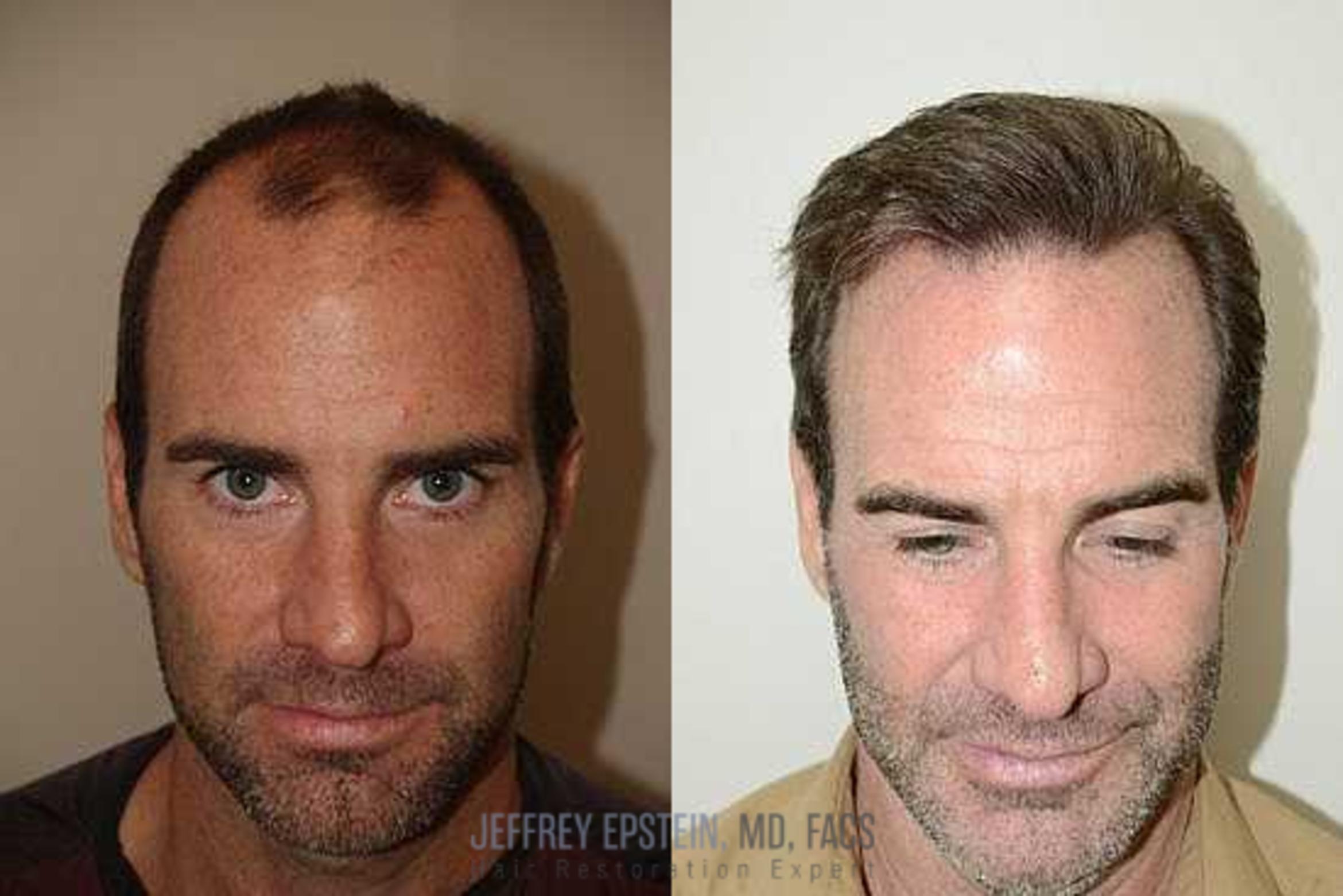 Before & After Hair Transplants For Men Case 86 View 3 View in Miami, FL