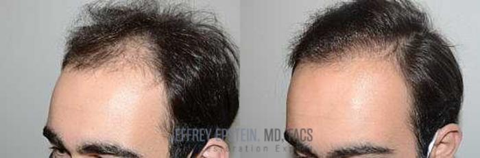 Before & After Hair Transplants For Men Case 88 View 1 View in Miami, FL
