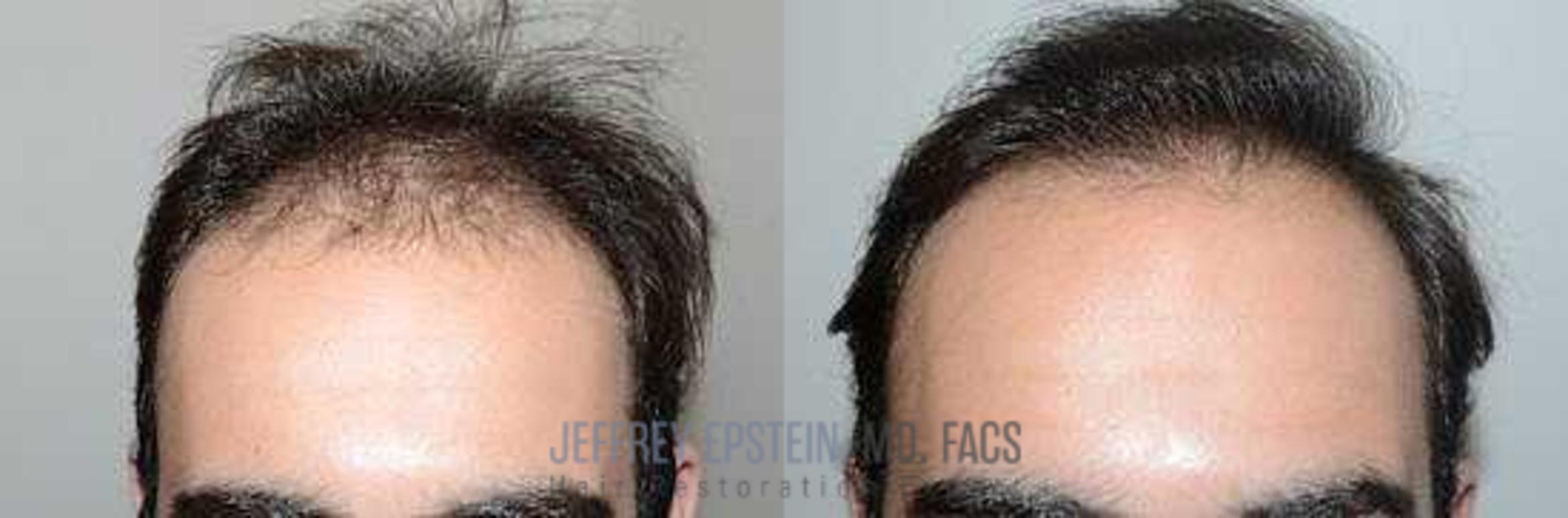 Before & After Hair Transplants For Men Case 88 View 2 View in Miami, FL
