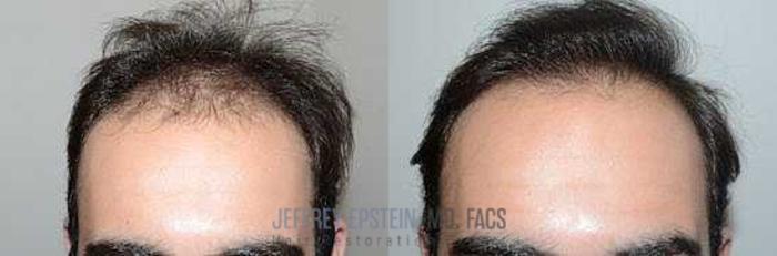 Before & After Hair Transplants For Men Case 88 View 2 View in Miami, FL